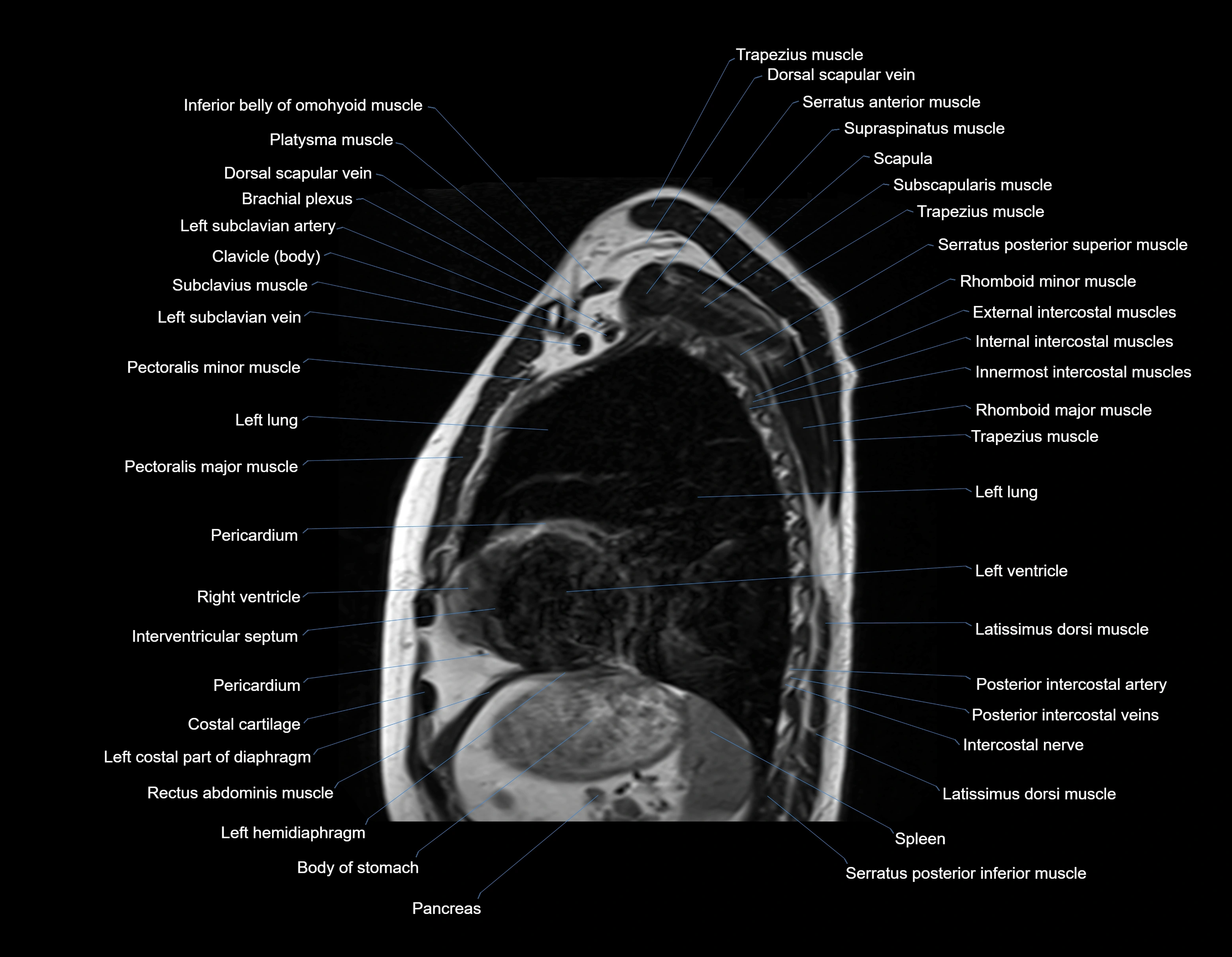 MRI chest (thorax) sagittal labelled cross sectional anatomy 3T radiology image-img-00001-00028.webp